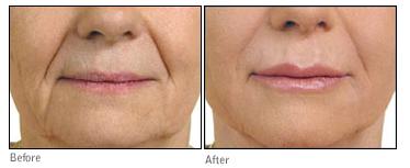 dermal fillers